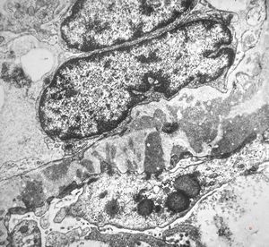 F,26y. | membranous glomerulopathy